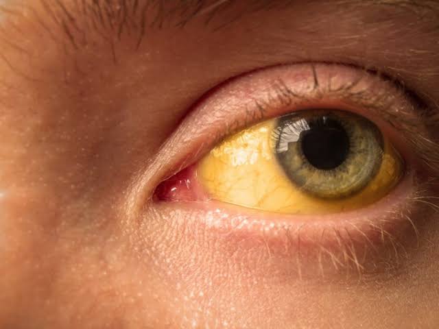 A 30 YEAR OLD MALE PRESENTS WITH JAUNDICE AND DARK URINE