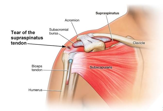 SOFT TISSUE DISORDERS