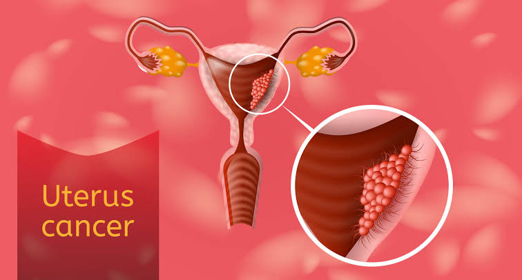 RISK FACTORS FOR UTERINE CANCER YOU SHOULD KNOW