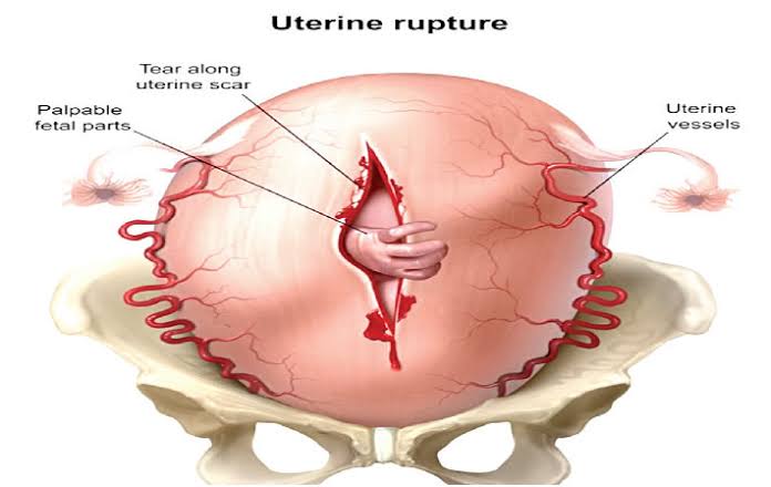 HOW A RUPTURED UTERUS AFFECTS PREGNANCY