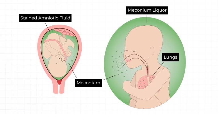 MECONIUM ASPIRATION SYNDROME: KEY INSIGHTS FROM A THOROUGH CLINICAL REVIEW