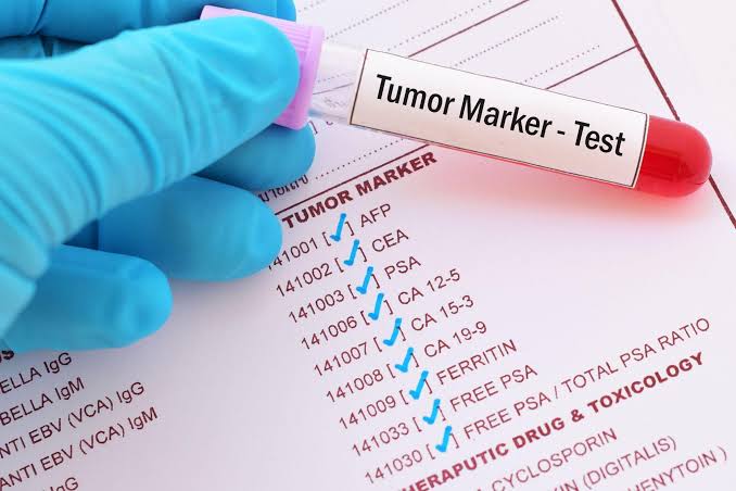 TUMOR MARKERS: WHAT YOU SHOULD KNOW ABOUT CANCER TESTING