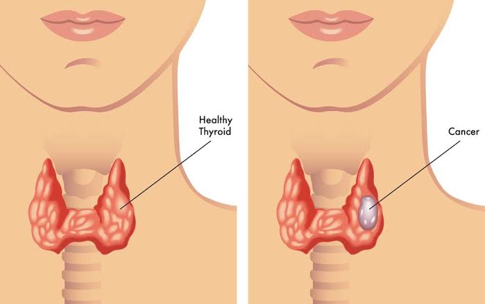 COMMON THYROID DISEASES AND WHAT THEY MEAN FOR YOUR HEALTH