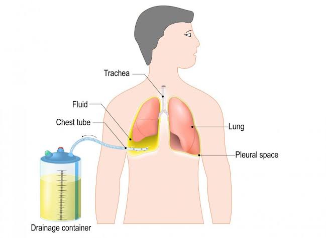 HOW CHEST TUBES HELP WITH LUNG PROBLEMS
