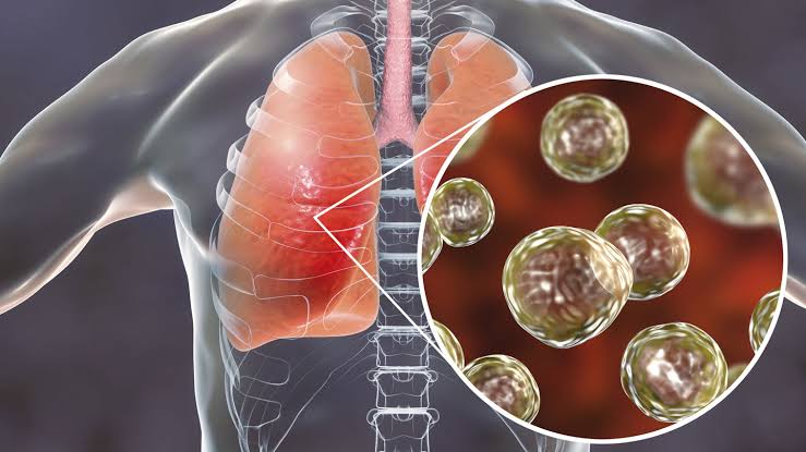 FUNGAL INFECTIONS OF THE RESPIRATORY SYSTEM EXPLAINED
