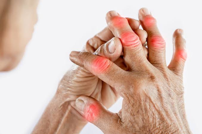 INNOVATIVE THERAPIES FOR RHEUMATOID ARTHRITIS: A LOOK AT EMERGING TREATMENTS INNOVATIVE THERAPIES FOR RHEUMATOID ARTHRITIS: A LOOK AT EMERGING TREATMENTS