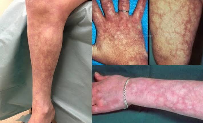 POLYARTERITIS NODOSA PROGNOSIS: WHAT PATIENTS NEED TO KNOW