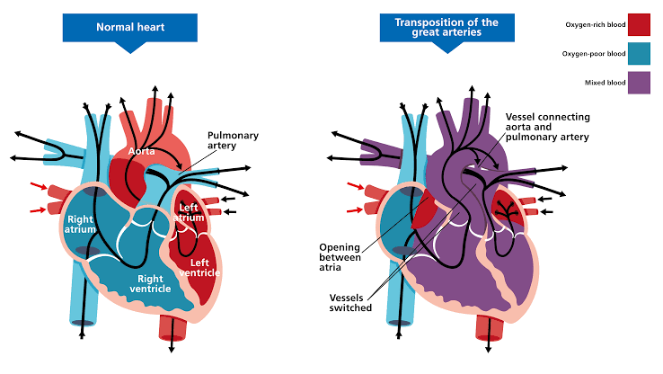 EFFECTIVE MANAGEMENT STRATEGIES FOR TRANSPOSITION OF THE GREAT ARTERIES IN PEDIATRIC PATIENTS