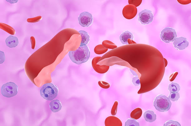 THE BASICS OF HEMOLYTIC ANEMIAS EXPLAINED