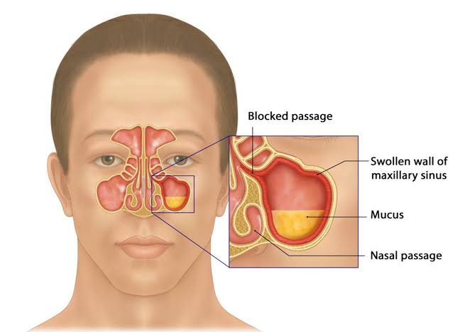 A CLOSER LOOK AT CHRONIC AND ACUTE RHINOSINUSITIS