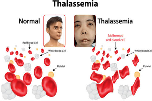 THALASSEMIA SYNDROME: WHAT YOU NEED TO KNOW