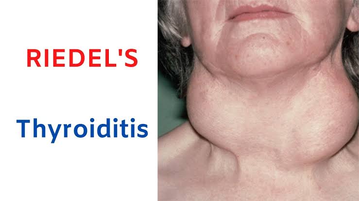 THYROID GLAND PATHOLOGY: COMMON DISEASES AND FEATURES