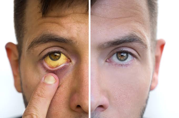 HOW JAUNDICE AFFECTS THE BODY AND TREATMENT OPTIONS