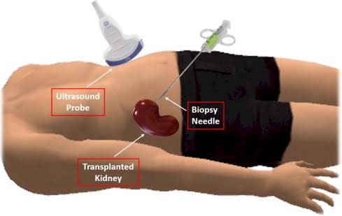 MANAGING DELAYED GRAFT FUNCTION IN KIDNEY TRANSPLANTS