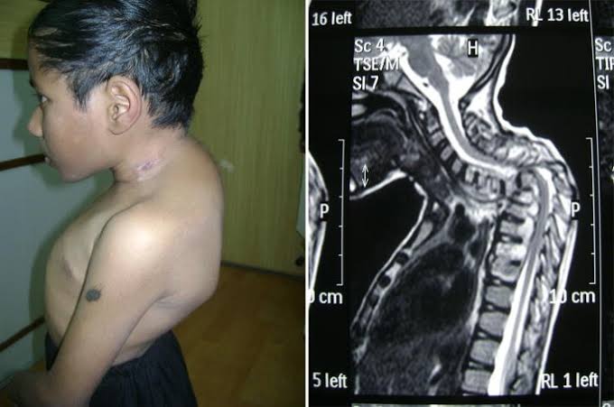 EXPLORING THE CAUSES AND DIAGNOSIS OF POTT’S DISEASE IN MODERN MEDICINE