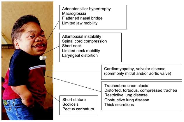 MUCOPOLYSACCHARIDOSIS EXPLAINED: CLINICAL FEATURES AND ASSOCIATED COMPLICATIONS