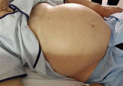 WHAT CAUSES ABDOMINAL SWELLING: KEY INSIGHTS YOU NEED