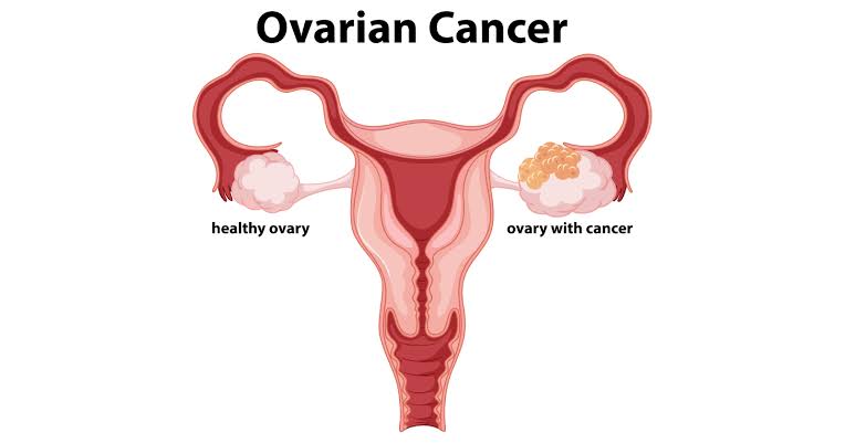 TREATMENTS FOR OVARIAN CANCER EXPLAINED