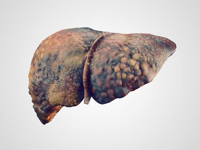UNDERSTANDING CHRONIC LIVER DISEASES: A DEEP DIVE INTO ALCOHOLIC AND NONALCOHOLIC FATTY LIVER DISEASE
