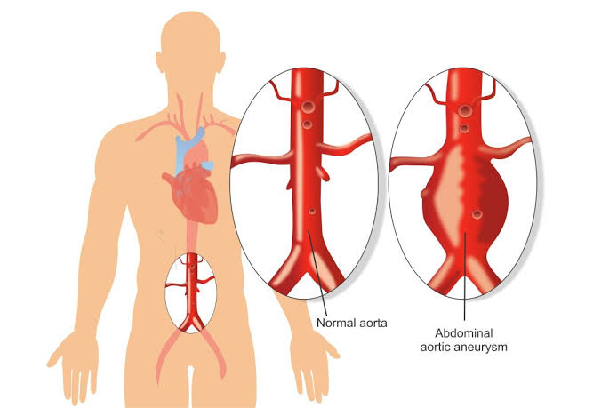 ANEURYSMS AND VASCULAR ANOMALIES