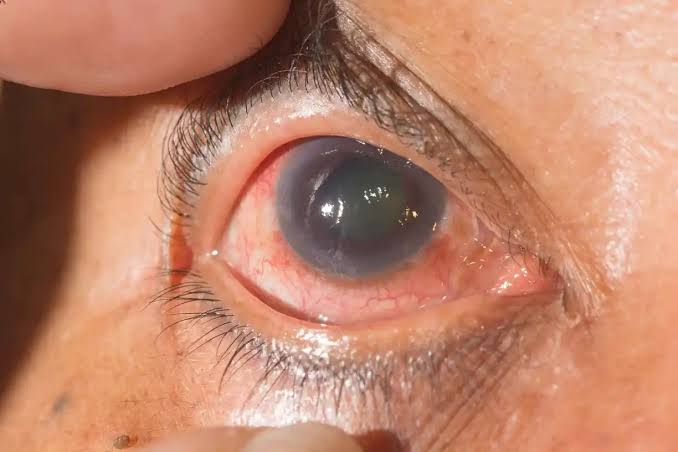 WHAT IS GLAUCOMA AND HOW IT AFFECTS YOUR EYES