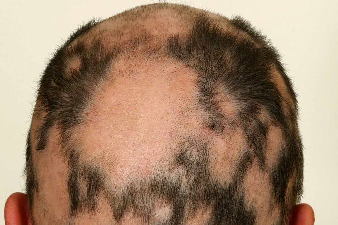 HAIR AND NAIL DISORDERS