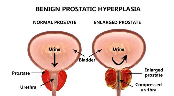 BENIGN PROSTATIC HYPERTROPHY: EFFECTIVE TREATMENT OPTIONS AND REMEDIES