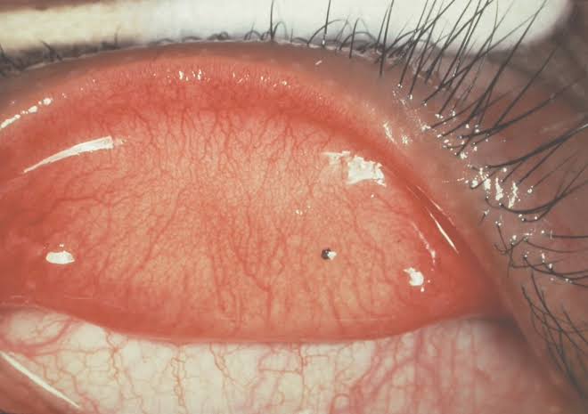 HOW TO SAFELY REMOVE A FOREIGN OBJECT FROM YOUR EYE: STEP-BY-STEP GUIDE