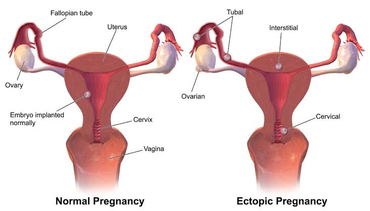 THE RISING INCIDENCE OF ECTOPIC PREGNANCY: WHAT YOU NEED TO KNOW