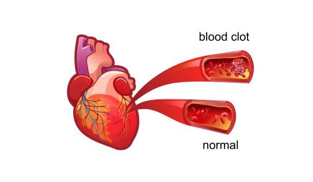 UNDERSTANDING HYPERCOAGULABLE DISORDERS AND THEIR RISKS