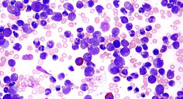 CHRONIC MYELOPROLIFERATIVE AND MYELODYSPLASTIC SYNDROMES