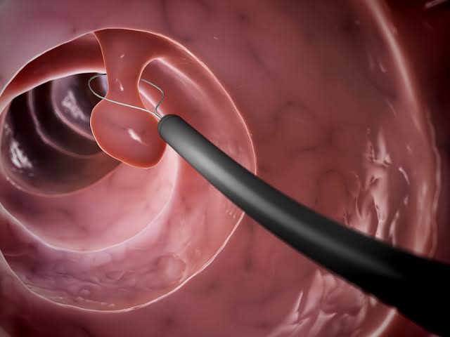 THE CLINICAL IMPACT OF COLONIC POLYPS: INSIGHTS INTO CLASSIFICATION AND PATHOGENESIS