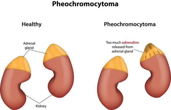 PHEOCHROMOCYTOMA: CLINICAL FEATURES, DIAGNOSIS, AND MANAGEMENT