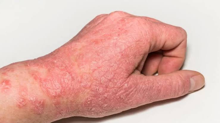 APPROACH TO PATIENTS WITH ECZEMATOUS RASH