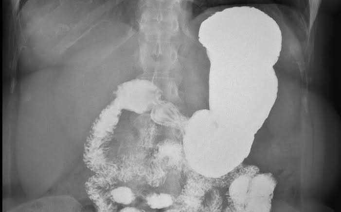 MASTERING THE BASICS: HOW TO UNDERSTAND NORMAL UPPER GASTROINTESTINAL X-RAYS