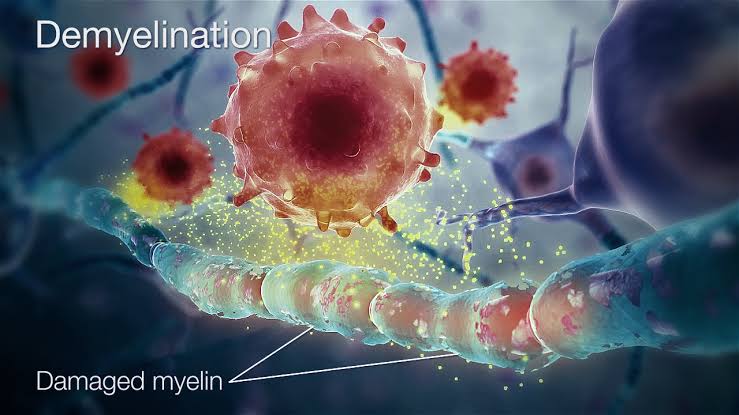 A CLOSER LOOK AT DEMYELINATING DISEASES