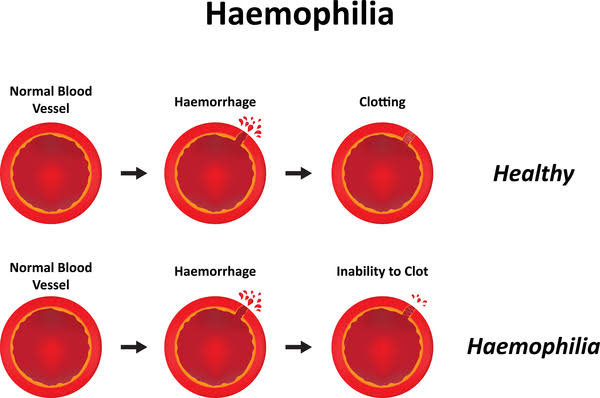 COAGULATION DISORDER: HEMOPHILIA
