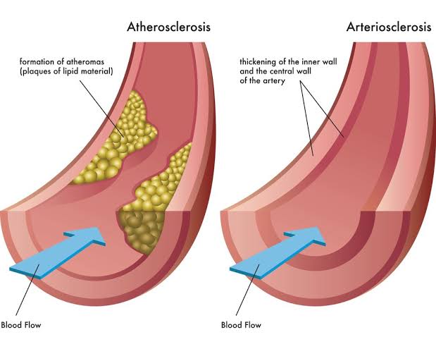 ARTERIOSCLEROSIS AND ATHEROSCLEROSIS OVERVIEW