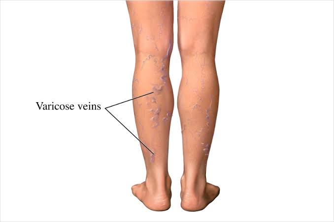 HOW VARICOSE VEINS DEVELOP: CAUSES AND PROCESS