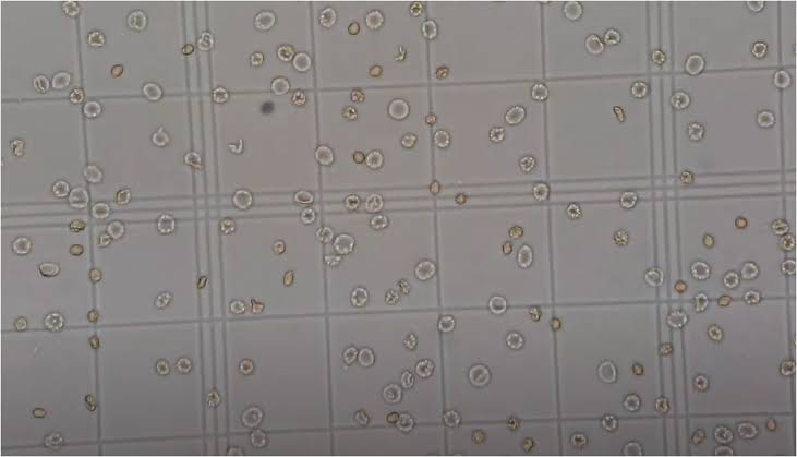 QUICK TIPS FOR RBC COUNT USING NEUBAUER CHAMBER