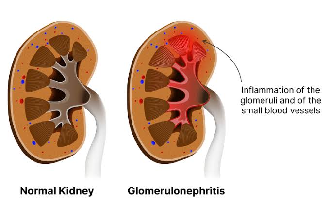 STEPS IN THE DEVELOPMENT OF GLOMERULONEPHRITIS