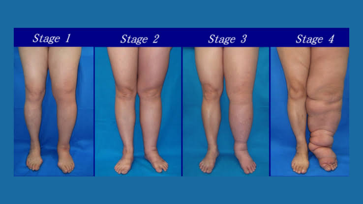 VENOUS AND LYMPHATIC DISORDERS