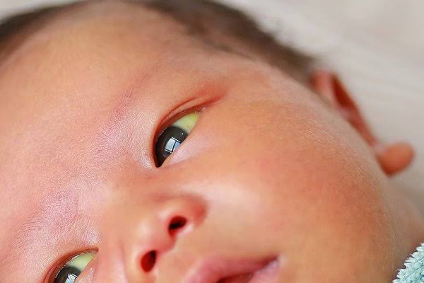 WHAT IS THE MOST COMMON CAUSE OF NEONATAL JAUNDICE IN THE FIRST WEEK OF LIFE?