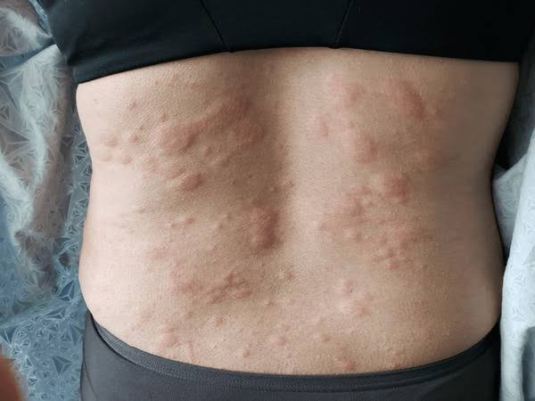 WHAT ARE HYPERSENSITIVITY REACTIONS AND HOW DO THEY HAPPEN