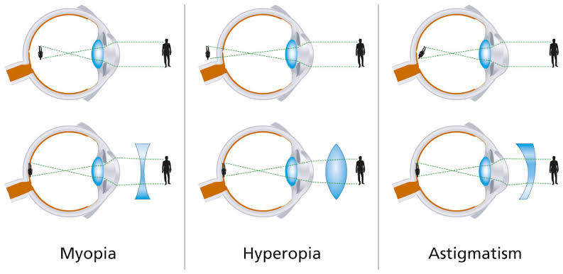 SIMPLE WAYS TO MANAGE AND CORRECT REFRACTIVE ERRORS
