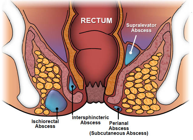 ANORECTAL INFECTIONS EXPLAINED: KEY CLASSIFICATIONS, RISK FACTORS, AND TREATMENT OPTIONS