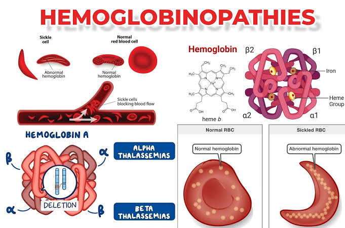 HEMOGLOBINOPATHIES AND HEMOGLOBIN ELECTROPHORESIS