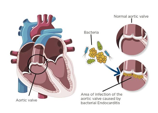 MICROBIOLOGY OF CARDITIS