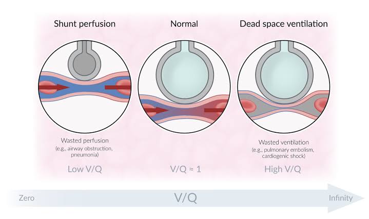 V/Q RATIO: WHY IT MATTERS IN LUNG FUNCTION TESTING