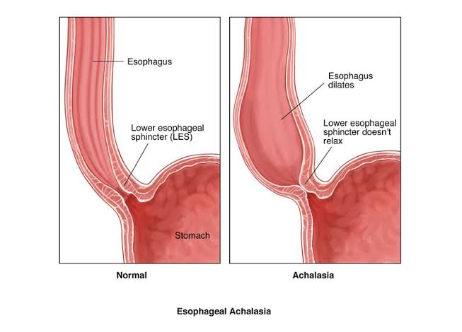 EFFECTIVE MANAGEMENT OF CARDIA ACHALASIA: ESSENTIAL DIAGNOSIS AND TREATMENT TIPS